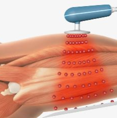 TERAPIA RADIOFALOWA UKIERUNKOWANA